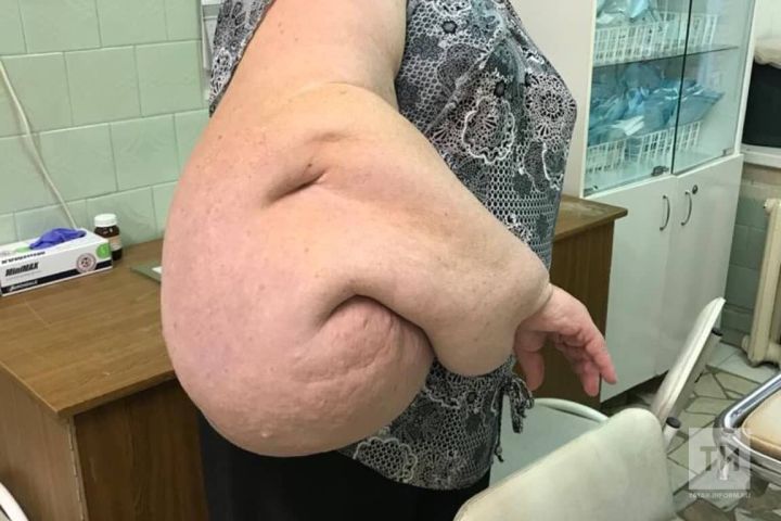 В Татарстане врачи удалили женщине опухоль весом в 20 кг